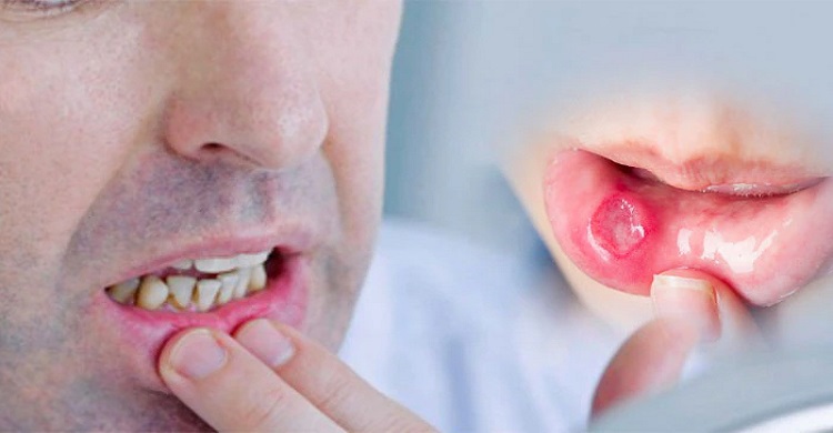 মুখে ঘা হওয়ার কারণ এবং প্রতিকারের উপায়