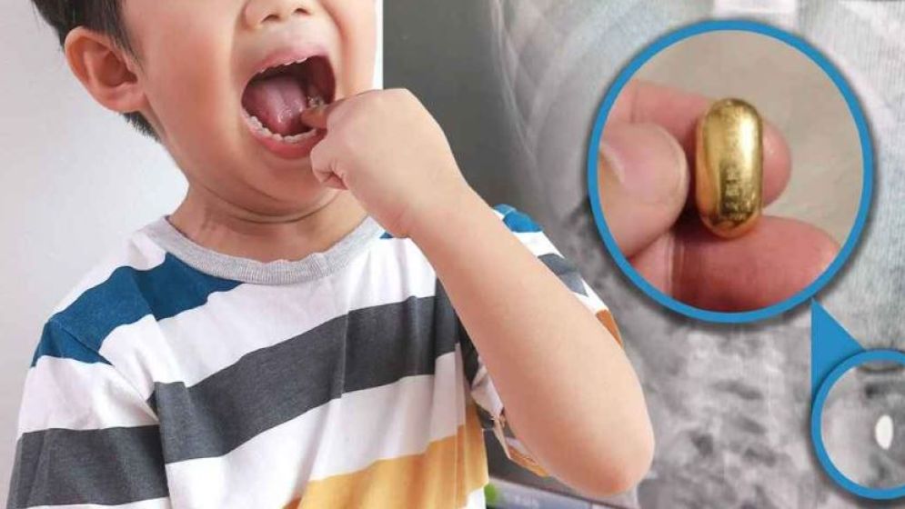 দামি এক সোনার বিচি গিলে ফেলল শিশু, ৫দিন অপেক্ষার পর যা ঘটল...