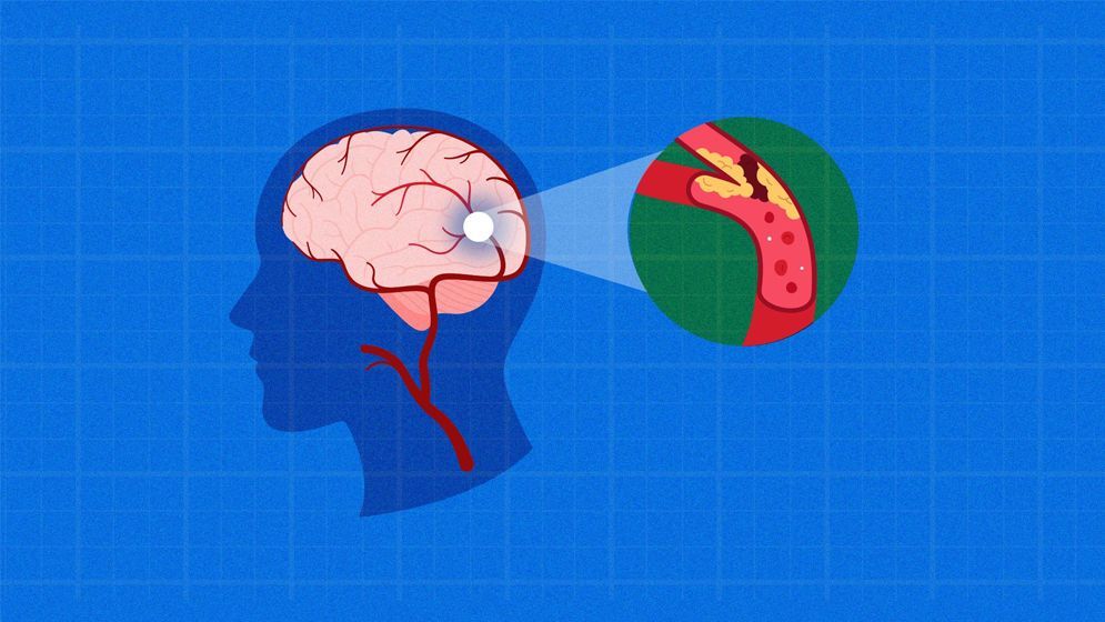 ব্রেইন স্ট্রোক: কিভাবে হয়, যা জানা জরুরি