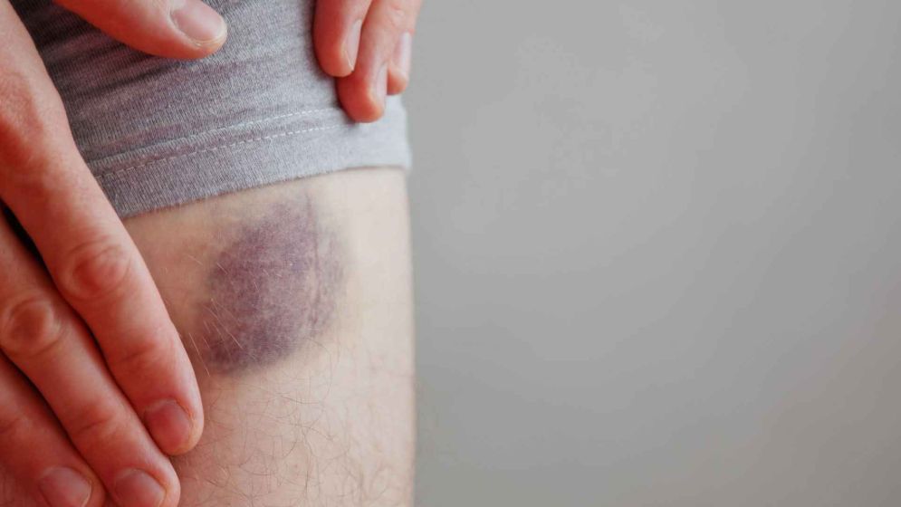 সামান্য আঘাতেই ত্বকে কালশিটে দাগ পড়া কীসের ইঙ্গিত?