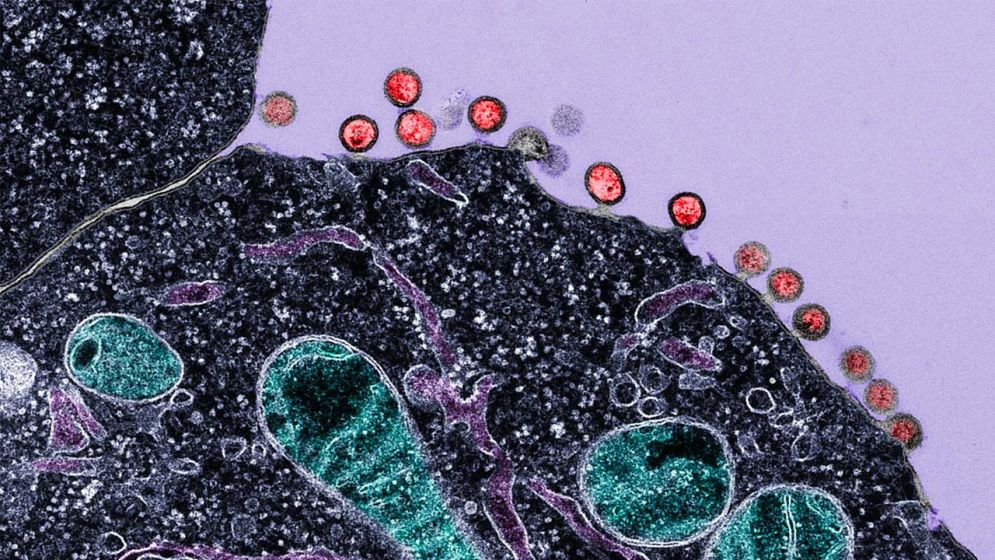 এইডস চিকিৎসায় আশার আলো, ১৮ মাস ওষুধ না খেয়েও সুস্থ ৭ রোগী