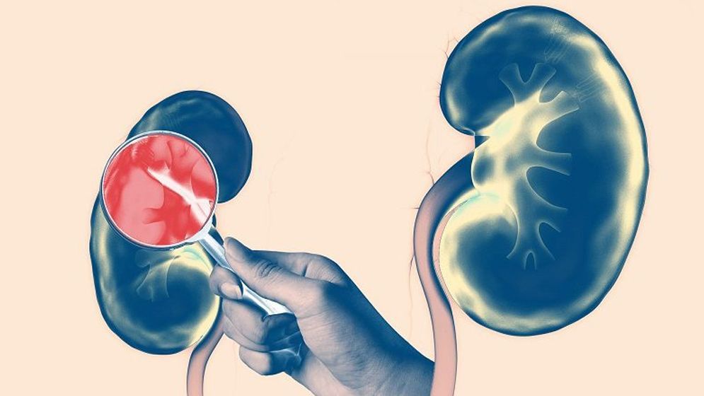 কিডনির রোগের আসল কারণ খুঁজে পেলেন গবেষকরা