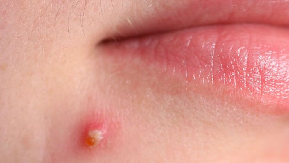 প্রাপ্তবয়স্কদের ব্রণ হওয়ার কারণ কী? জানুন দূর করার উপায়