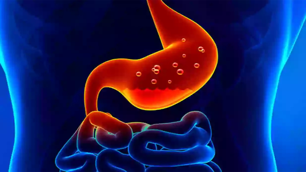 রমজানে গ্যাস্ট্রিক বা অ্যাসিডিটি থেকে বাঁচার ১০টি ঘরোয়া উপায়