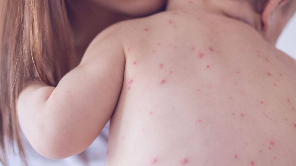 হামের লক্ষণ ও প্রতিকার, যা জানা জরুরি