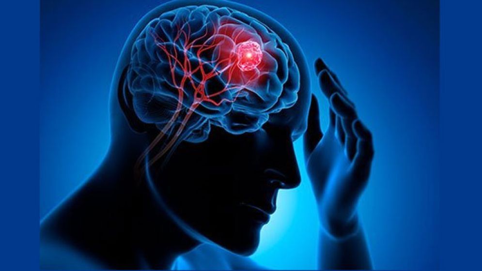 মস্তিষ্কের টিউমারের যে ৭টি লক্ষণ ভুলেও এড়িয়ে যাবেন না