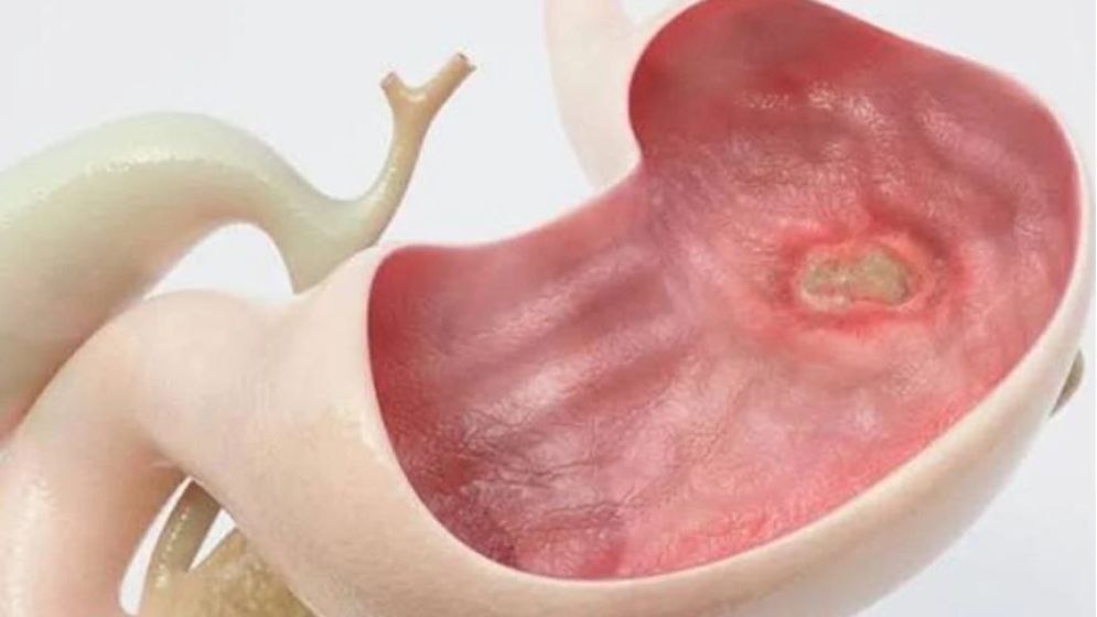 কিভাবে বুঝবেন আপনার আলসার হয়েছে